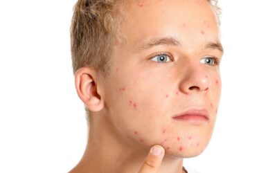Acne giovanile: prevenirla e curarla