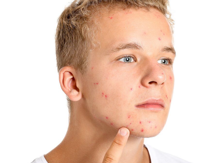 Acne giovanile: prevenirla e curarla