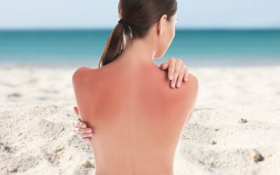 Eritema solare: come riconoscerlo e come trattarlo